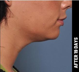 Ultherapy Before & After Patient #1548